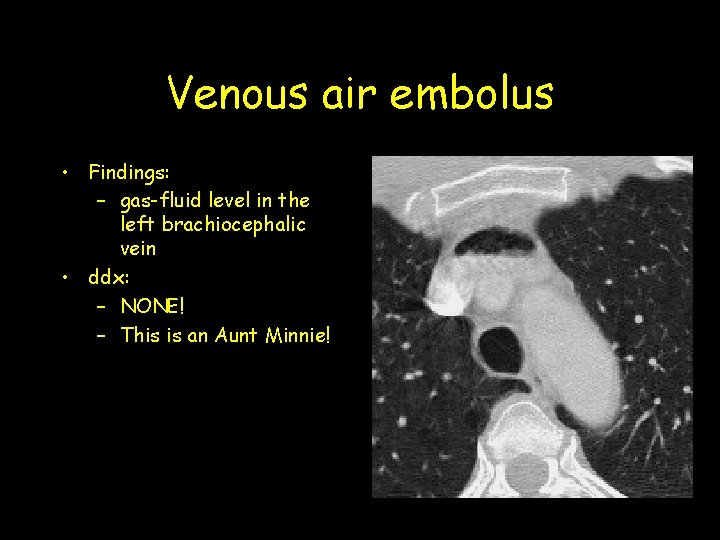 Venous air embolus • Findings: – gas-fluid level in the left brachiocephalic vein •