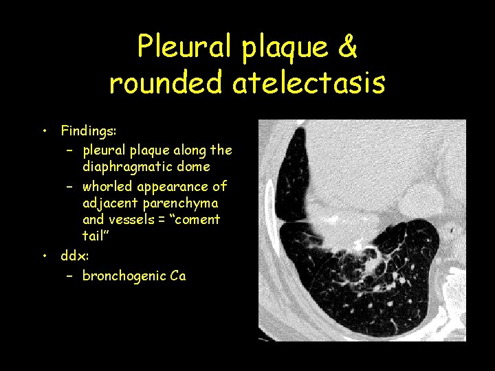 Pleural plaque & rounded atelectasis • Findings: – pleural plaque along the diaphragmatic dome