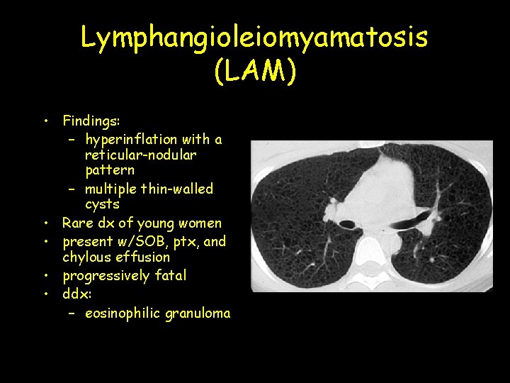 Lymphangioleiomyamatosis (LAM) • Findings: – hyperinflation with a reticular-nodular pattern – multiple thin-walled cysts