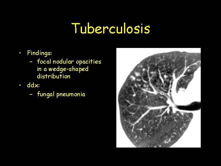 Tuberculosis • Findings: – focal nodular opacities in a wedge-shaped distribution • ddx: –