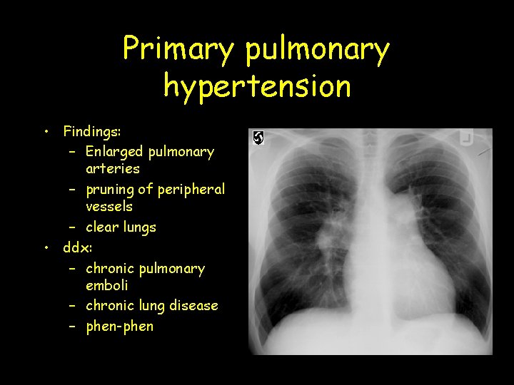 Primary pulmonary hypertension • Findings: – Enlarged pulmonary arteries – pruning of peripheral vessels