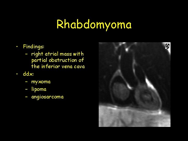 Rhabdomyoma • Findings: – right atrial mass with partial obstruction of the inferior vena