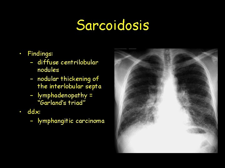 Sarcoidosis • Findings: – diffuse centrilobular nodules – nodular thickening of the interlobular septa