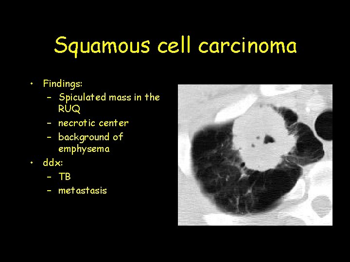 Squamous cell carcinoma • Findings: – Spiculated mass in the RUQ – necrotic center