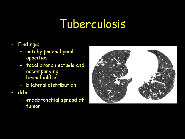 Tuberculosis • Findings: – patchy parenchymal opacities – focal bronchiectasis and accompanying bronchioliltis –