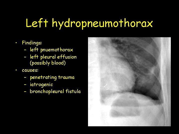 Left hydropneumothorax • Findings: – left pnuemothorax – left pleural effusion (possibly blood) •