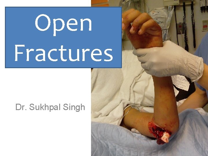 Open Fractures Dr. Sukhpal Singh 