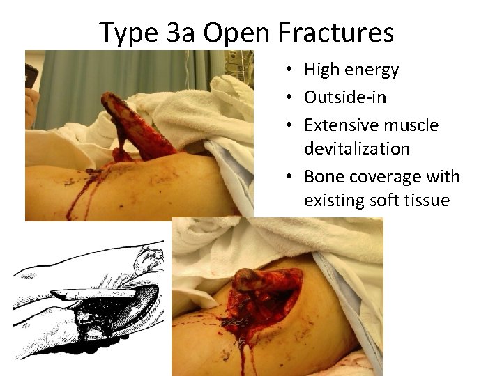 Type 3 a Open Fractures • High energy • Outside-in • Extensive muscle devitalization