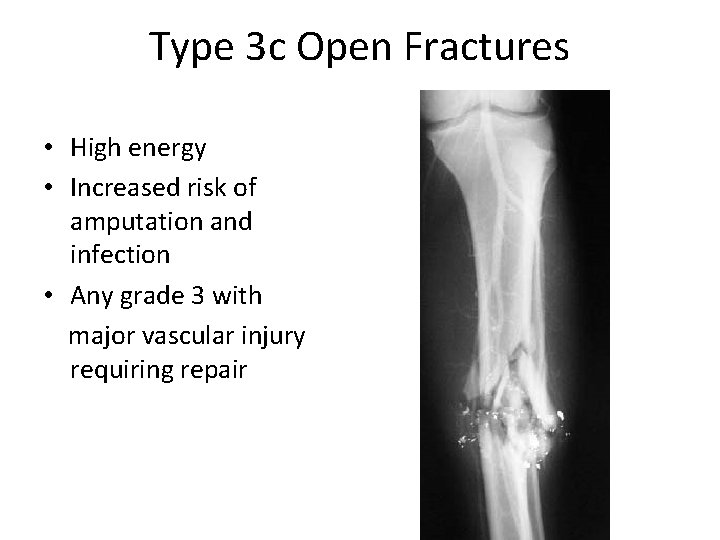 Type 3 c Open Fractures • High energy • Increased risk of amputation and