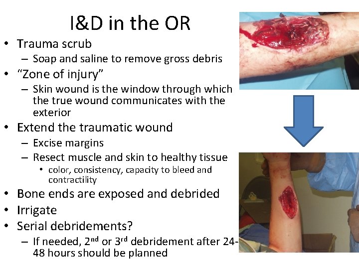 I&D in the OR • Trauma scrub – Soap and saline to remove gross