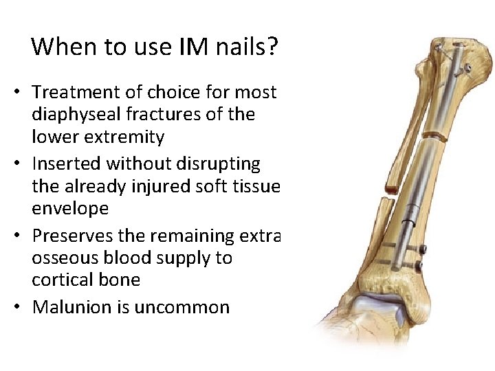 When to use IM nails? • Treatment of choice for most diaphyseal fractures of