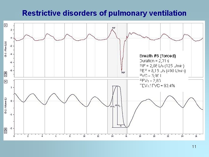 Restrictive disorders of pulmonary ventilation 11 