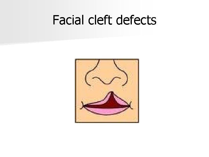 Facial cleft defects 