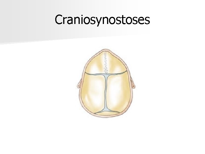 Craniosynostoses 