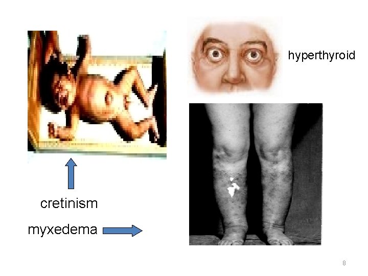 hyperthyroid cretinism myxedema 8 hyperthyroid cretinism myxedema 8