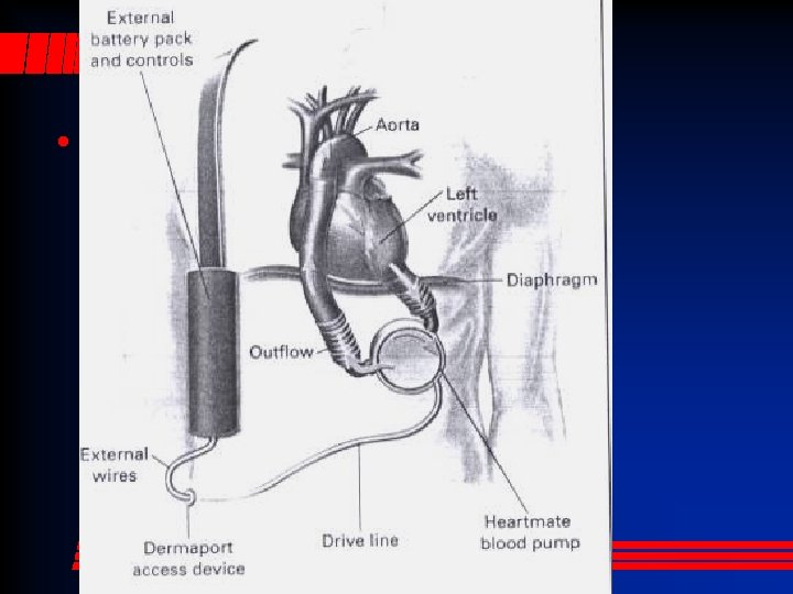 Centrifugal LVAS • The patient has no pulse! 