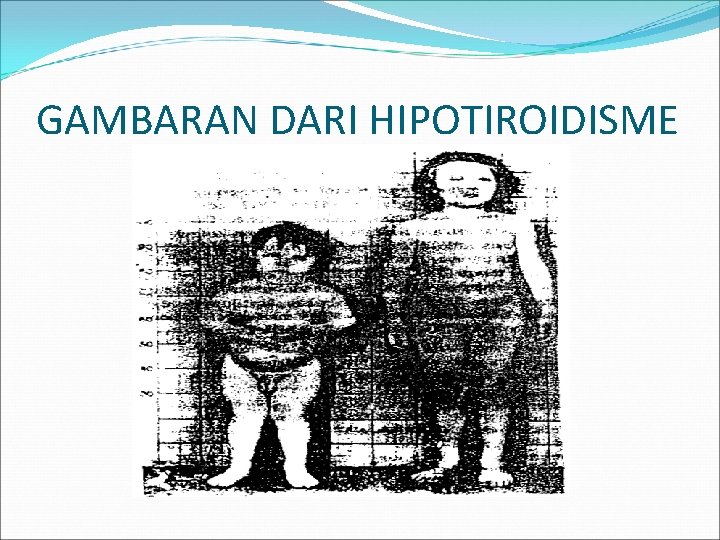 GAMBARAN DARI HIPOTIROIDISME 