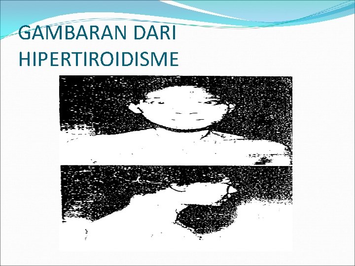 GAMBARAN DARI HIPERTIROIDISME 