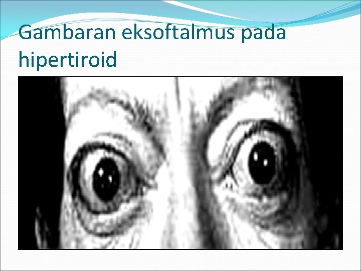 Gambaran eksoftalmus pada hipertiroid 