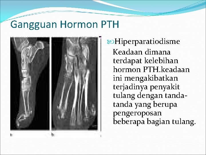 Gangguan Hormon PTH Hiperparatiodisme Keadaan dimana terdapat kelebihan hormon PTH. keadaan ini mengakibatkan terjadinya