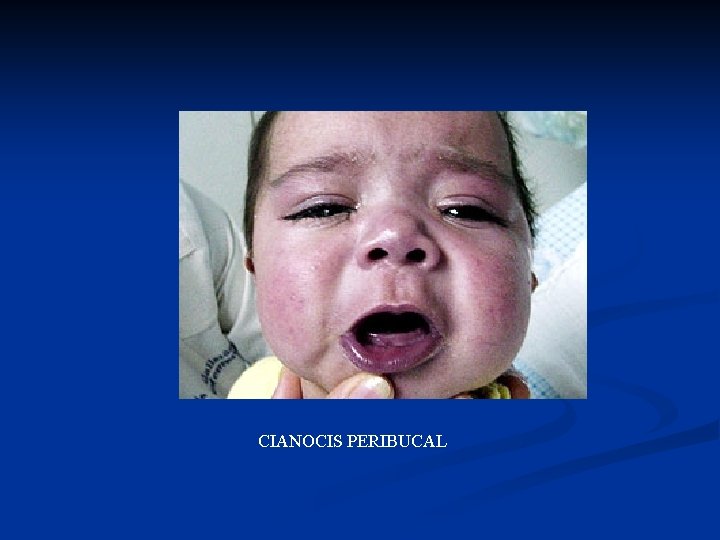 CIANOCIS PERIBUCAL 