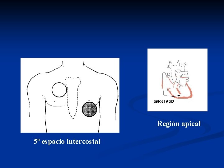 Región apical 5º espacio intercostal 