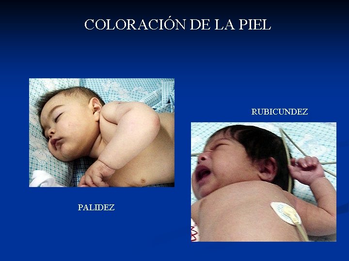 COLORACIÓN DE LA PIEL RUBICUNDEZ PALIDEZ 