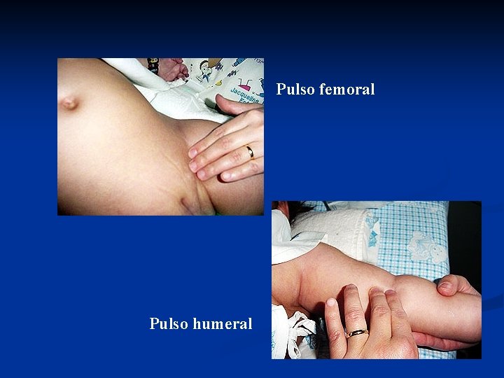 Pulso femoral Pulso humeral 