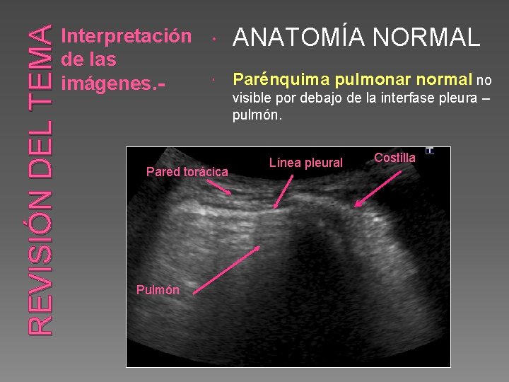 REVISIÓN DEL TEMA Interpretación ANATOMÍA NORMAL de las Parénquima pulmonar normal no imágenes. visible