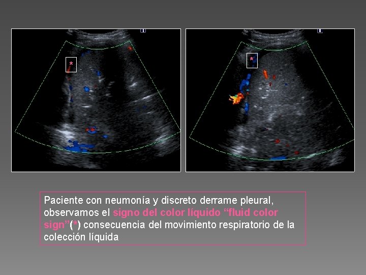 * * Paciente con neumonía y discreto derrame pleural, observamos el signo del color