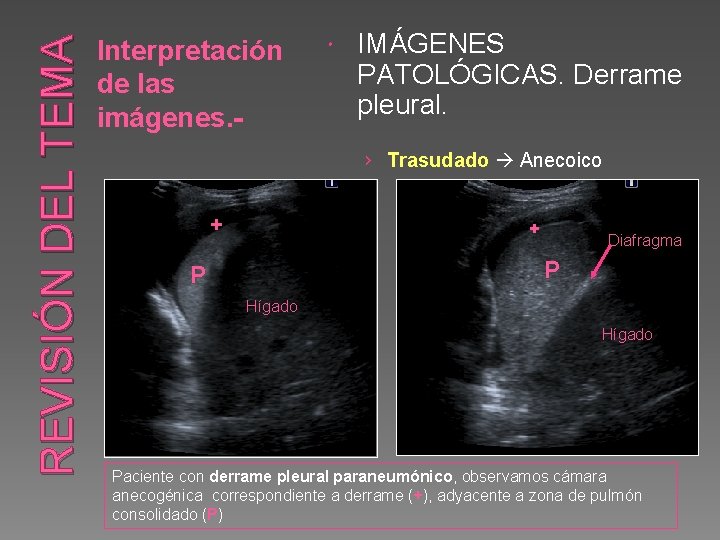 REVISIÓN DEL TEMA Interpretación de las imágenes. - IMÁGENES PATOLÓGICAS. Derrame pleural. › Trasudado