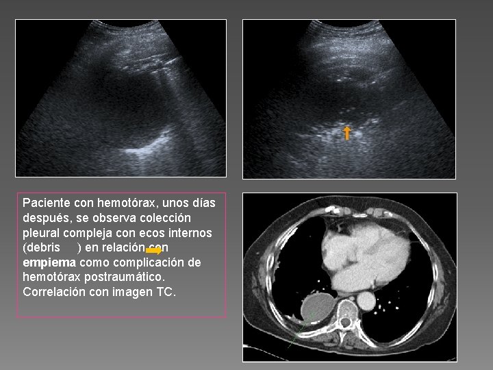 Paciente con hemotórax, unos días después, se observa colección pleural compleja con ecos internos