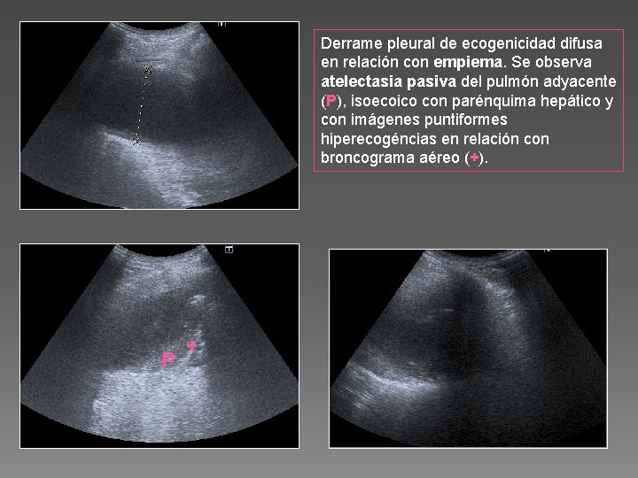 Derrame pleural de ecogenicidad difusa en relación con empiema. Se observa atelectasia pasiva del