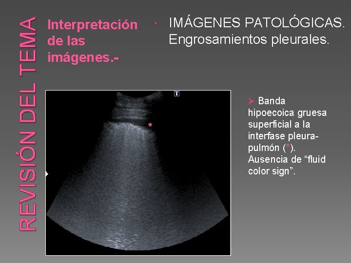 REVISIÓN DEL TEMA Interpretación de las imágenes. - IMÁGENES PATOLÓGICAS. Engrosamientos pleurales. Ø Banda