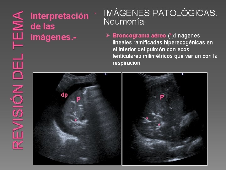 REVISIÓN DEL TEMA Interpretación IMÁGENES PATOLÓGICAS. Neumonía. de las Ø Broncograma aéreo (*): imágenes.