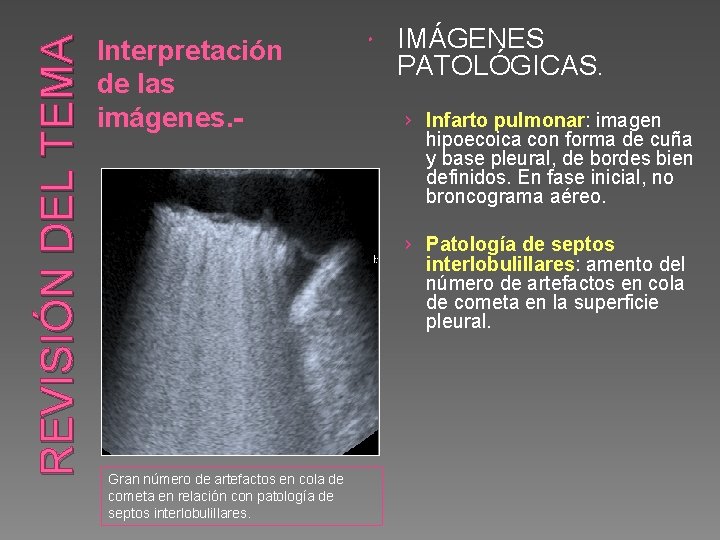 REVISIÓN DEL TEMA Interpretación de las imágenes. - IMÁGENES PATOLÓGICAS. › Infarto pulmonar: imagen