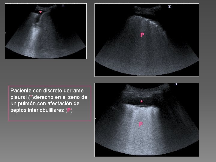 * P Paciente con discreto derrame pleural (*)derecho en el seno de un pulmón