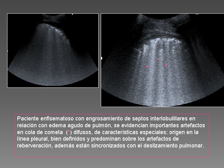 * * * Paciente enfisematoso con engrosamiento de septos interlobulillares en relación con edema