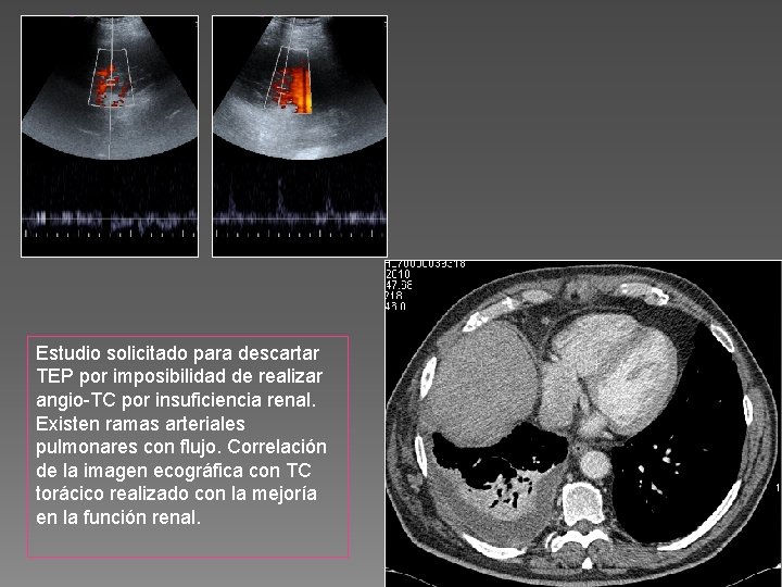 Estudio solicitado para descartar TEP por imposibilidad de realizar angio-TC por insuficiencia renal. Existen