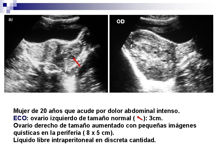 OD Mujer de 20 años que acude por dolor abdominal intenso. ECO: ovario izquierdo