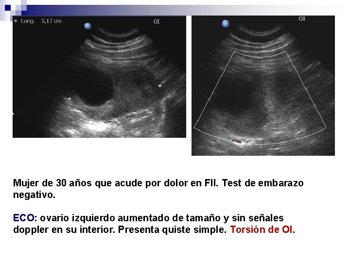 Mujer de 30 años que acude por dolor en FII. Test de embarazo negativo.