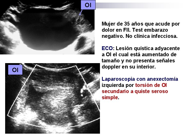 OI Mujer de 35 años que acude por dolor en FII. Test embarazo negativo.