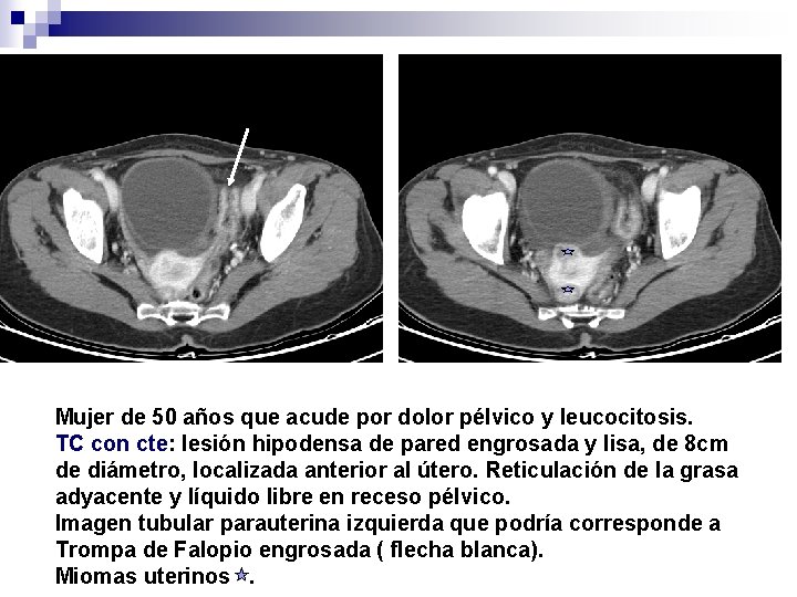 Mujer de 50 años que acude por dolor pélvico y leucocitosis. TC con cte: