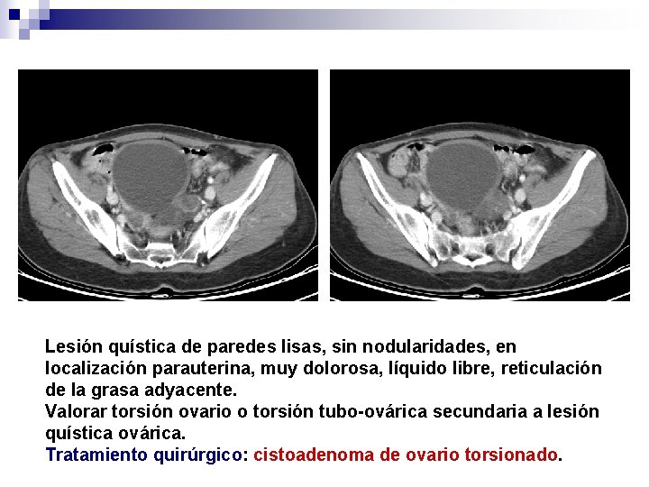 Lesión quística de paredes lisas, sin nodularidades, en localización parauterina, muy dolorosa, líquido libre,