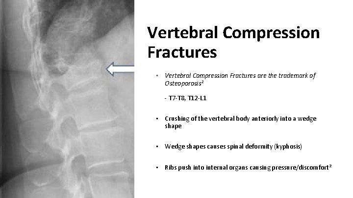 Vertebral Compression Fractures • Vertebral Compression Fractures are the trademark of Osteoporosis 2 -