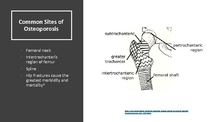 Common Sites of Osteoporosis • Femoral neck • Intertrochanteric region of femur • Spine