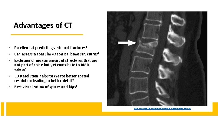 Advantages of CT • Excellent at predicting vertebral fractures 4 • Can assess trabecular