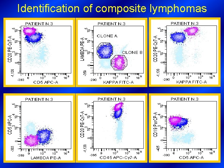 Identification of composite lymphomas 