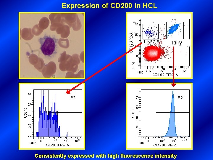 Expression of CD 200 in HCL hairy Consistently expressed with high fluorescence intensity 