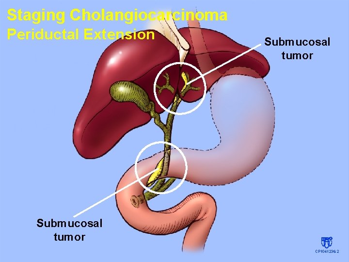 Staging Cholangiocarcinoma Periductal Extension Submucosal tumor CP 1041236 -2 